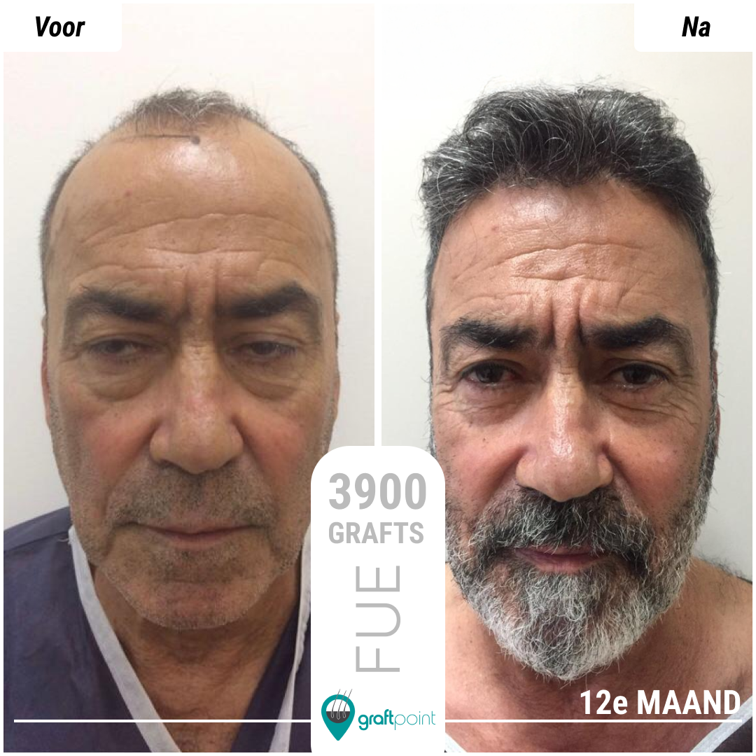 Graft Point saç ekimi öncesi ve sonrası sonuç 7